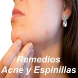 Remedios Naturales para Eliminar el Acné Gratis icon